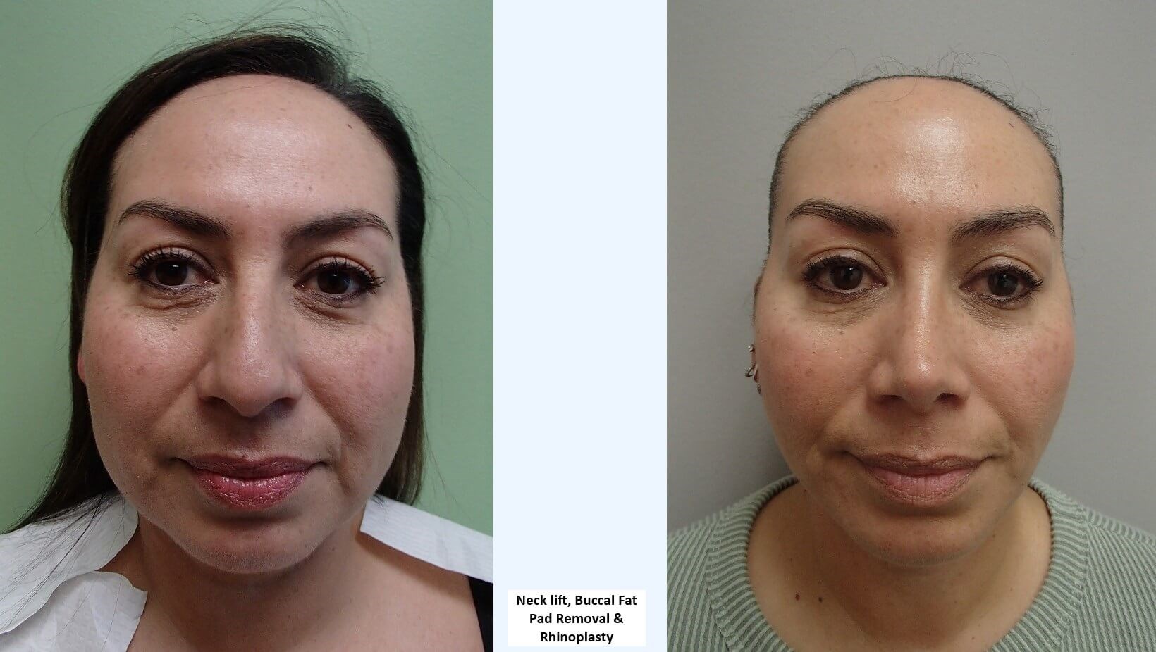 Neck Lift Before