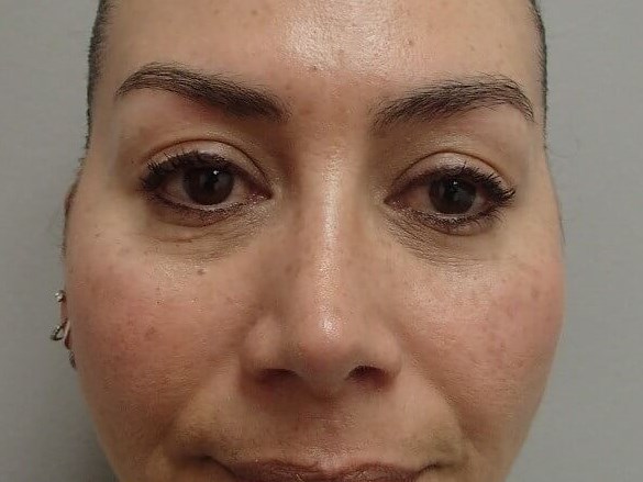 Rhinoplasty (Nose Job) After