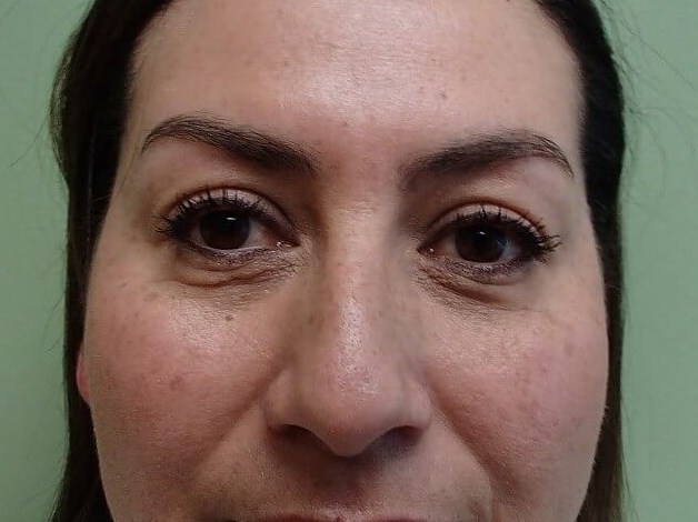 Rhinoplasty (Nose Job) Before