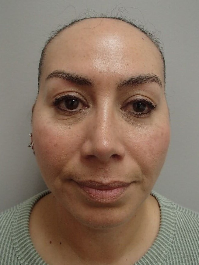 Neck Lift After