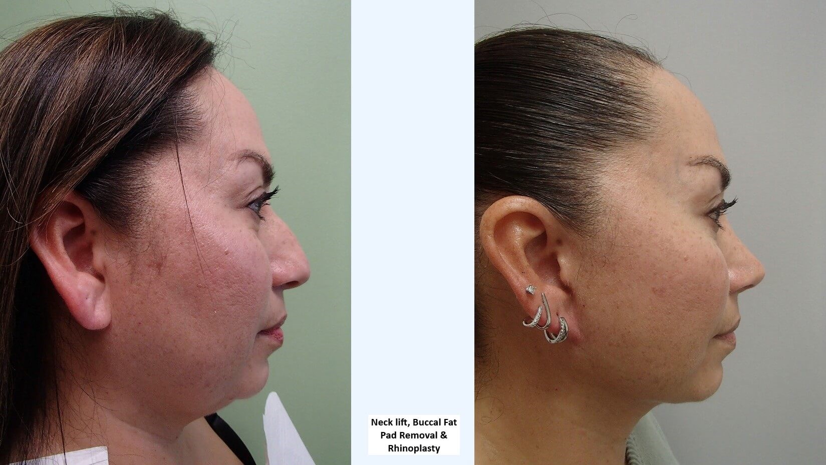 Neck Lift Before