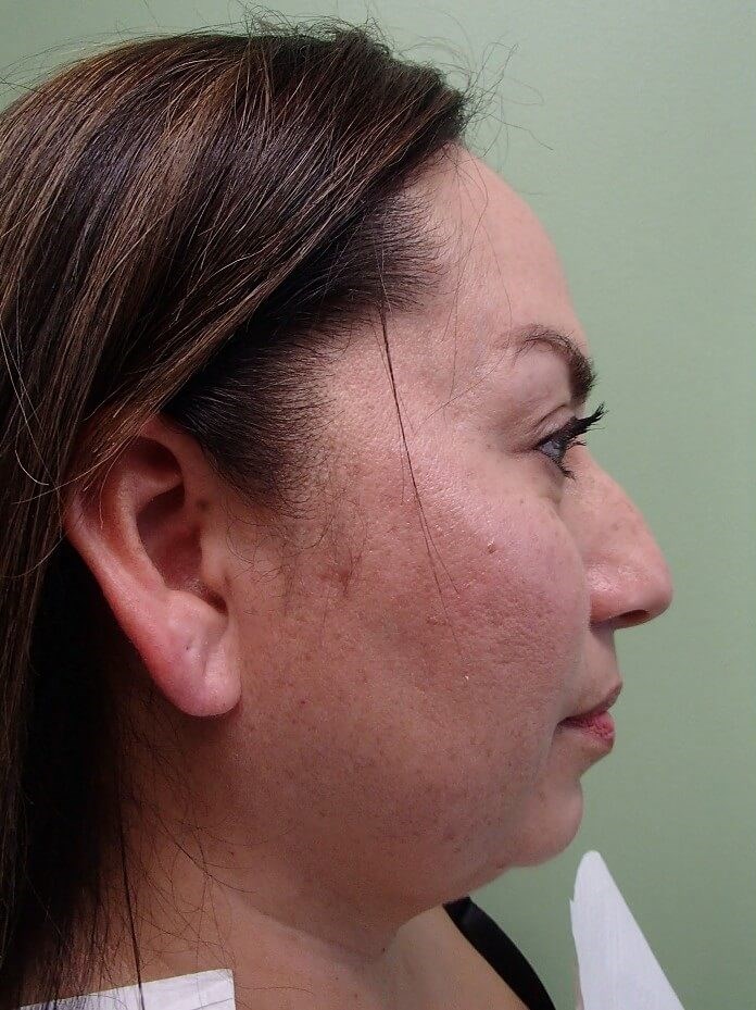 Neck Lift Before