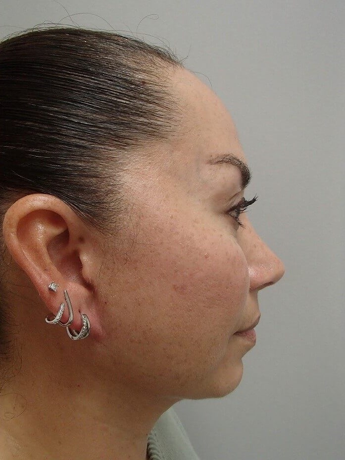 Neck Lift After