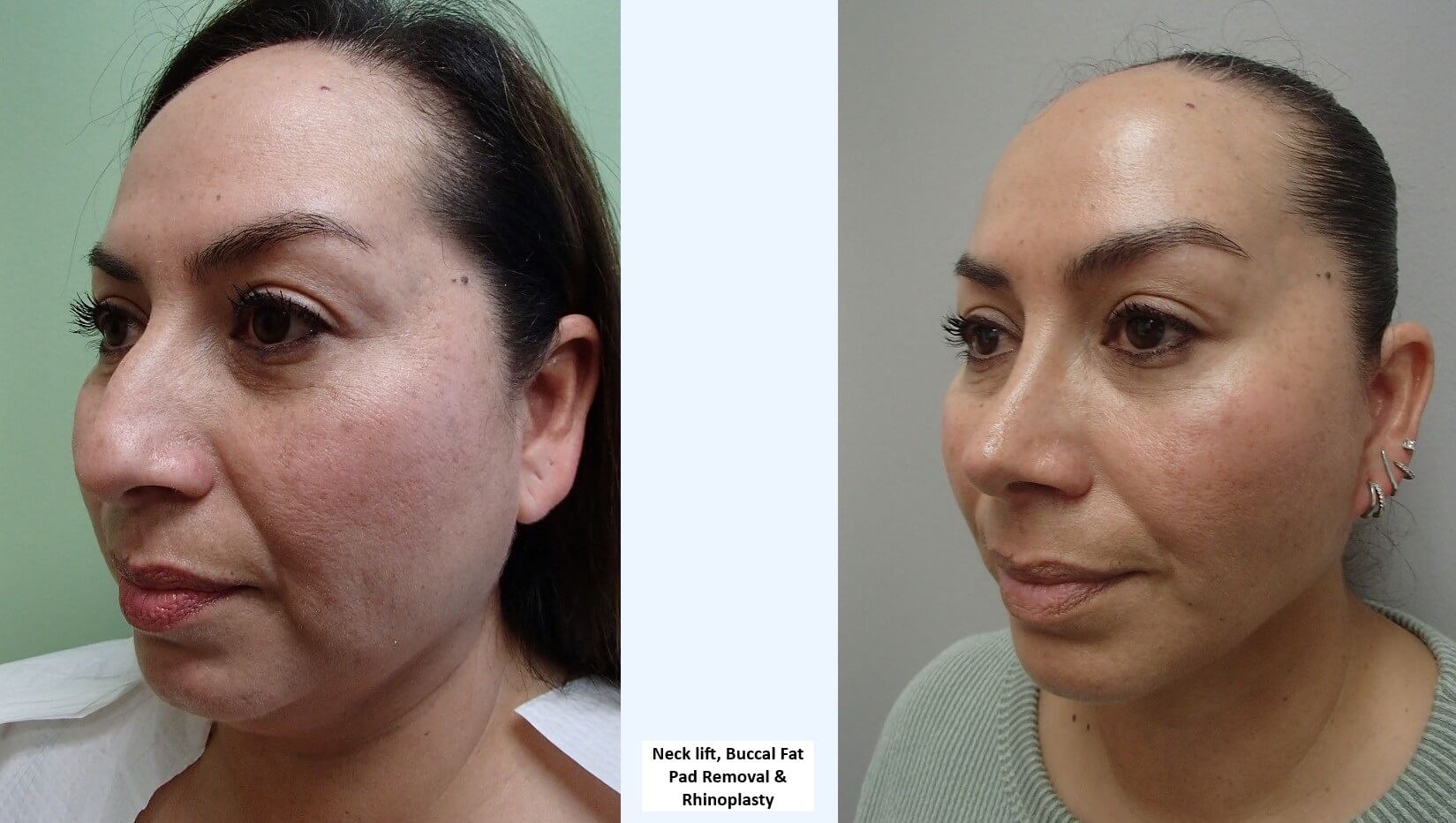 Neck Lift Before