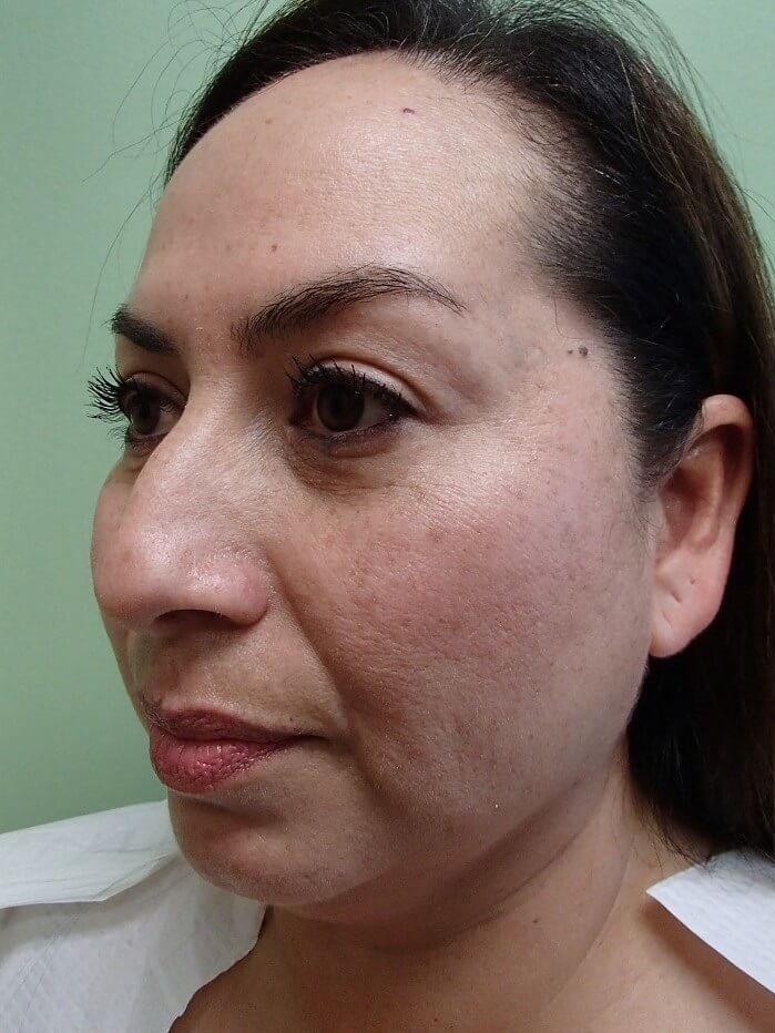 Neck Lift Before