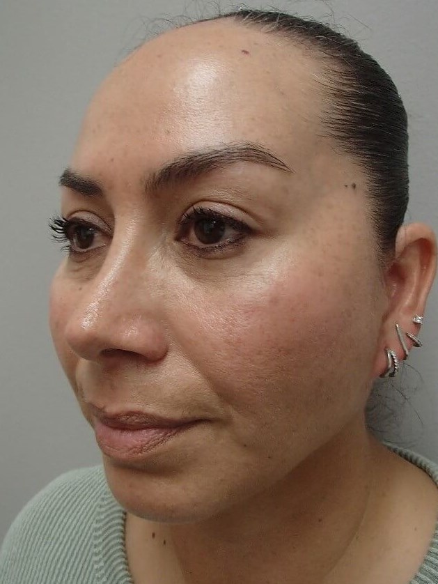 Neck Lift After