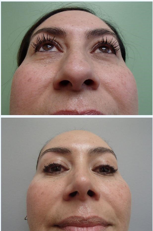 Rhinoplasty (Nose Job) Before