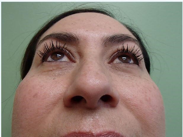 Rhinoplasty (Nose Job) Before