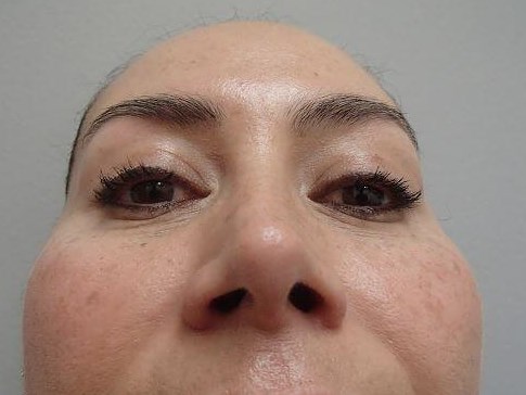 Rhinoplasty (Nose Job) After