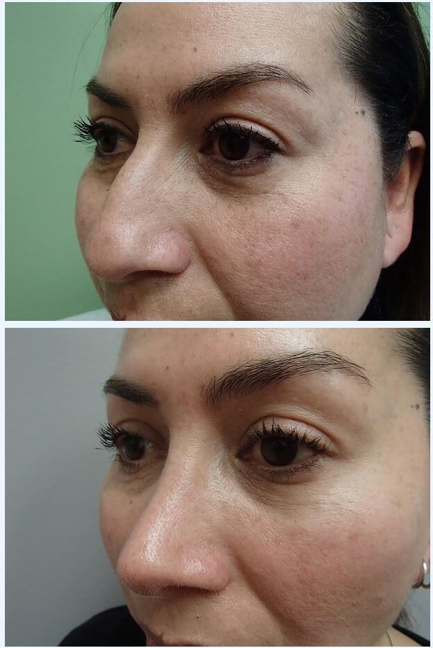 Rhinoplasty (Nose Job) Before