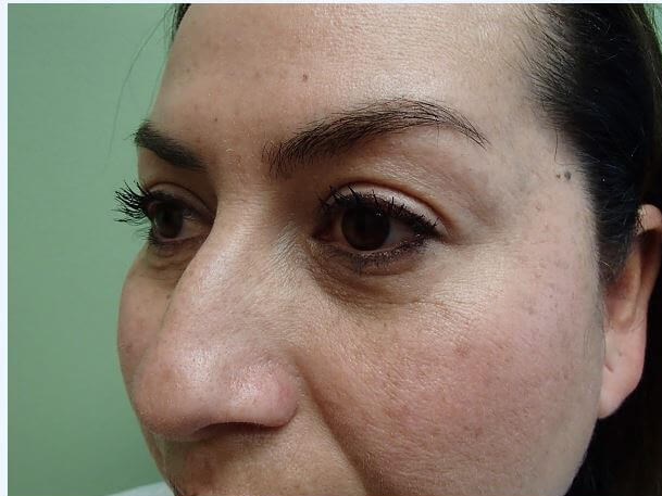 Rhinoplasty (Nose Job) Before