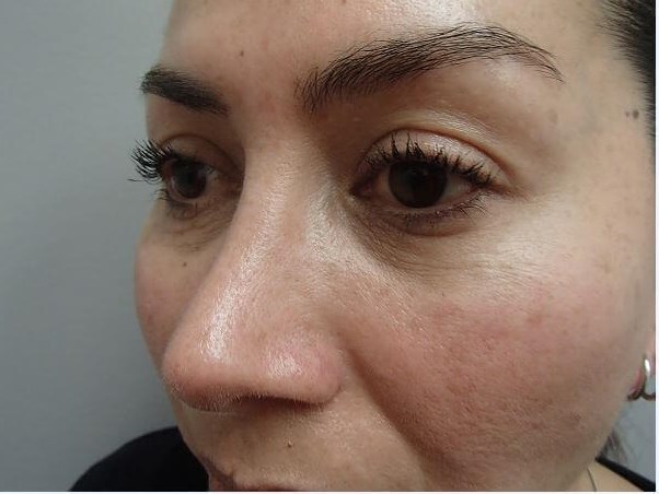 Rhinoplasty (Nose Job) After