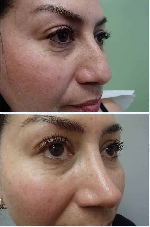 Rhinoplasty (Nose Job) Before