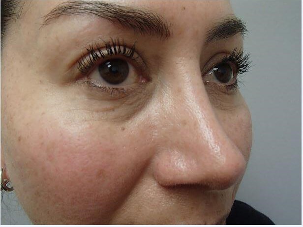 Rhinoplasty (Nose Job) After
