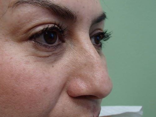 Rhinoplasty (Nose Job) Before