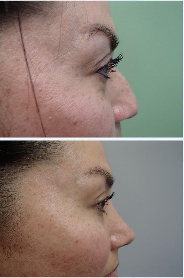 Rhinoplasty (Nose Job) Before