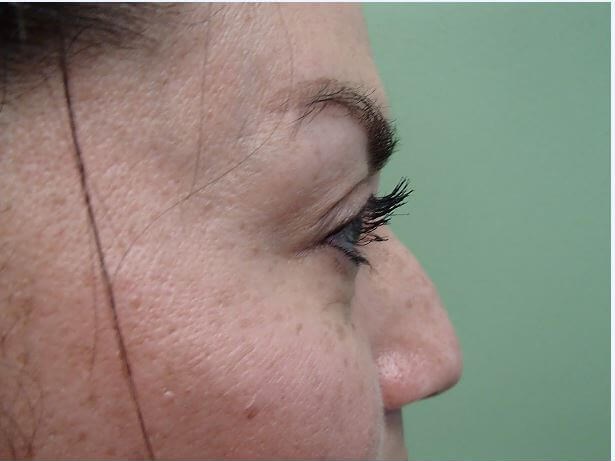 Rhinoplasty (Nose Job) Before