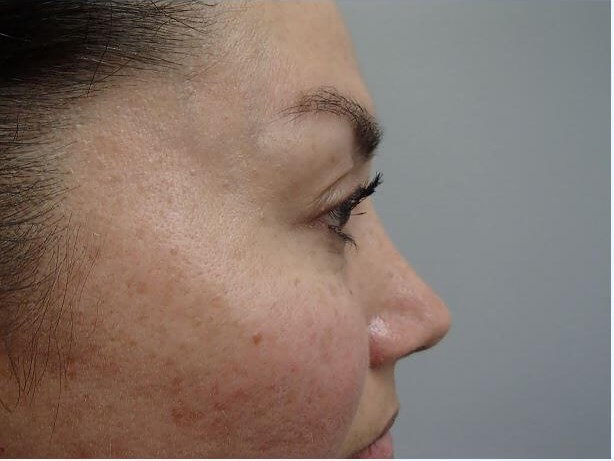 Rhinoplasty (Nose Job) After