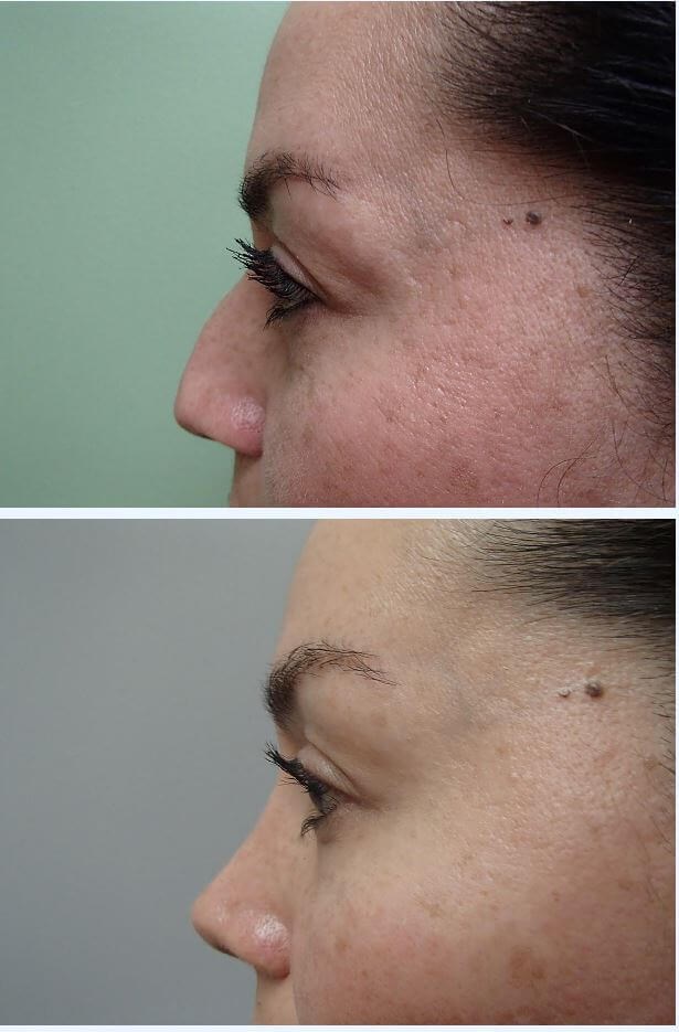 Rhinoplasty (Nose Job) Before