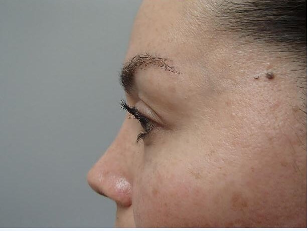 Rhinoplasty (Nose Job) After