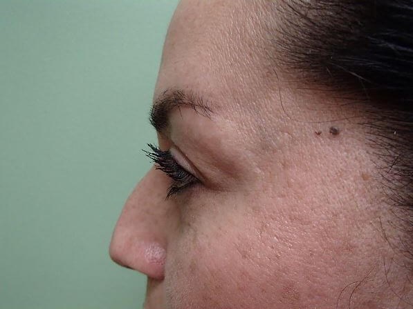 Rhinoplasty (Nose Job) Before