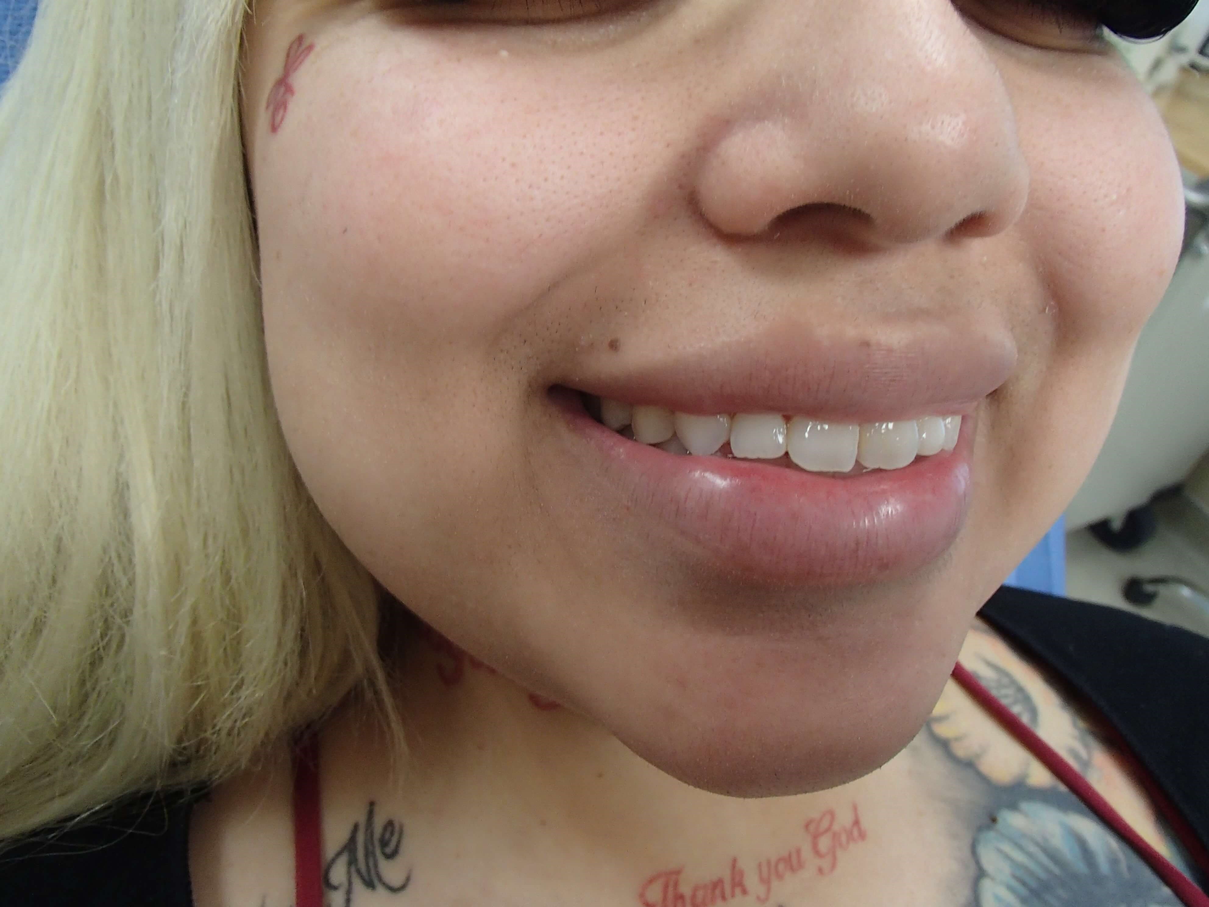 Timeless Dimples Before