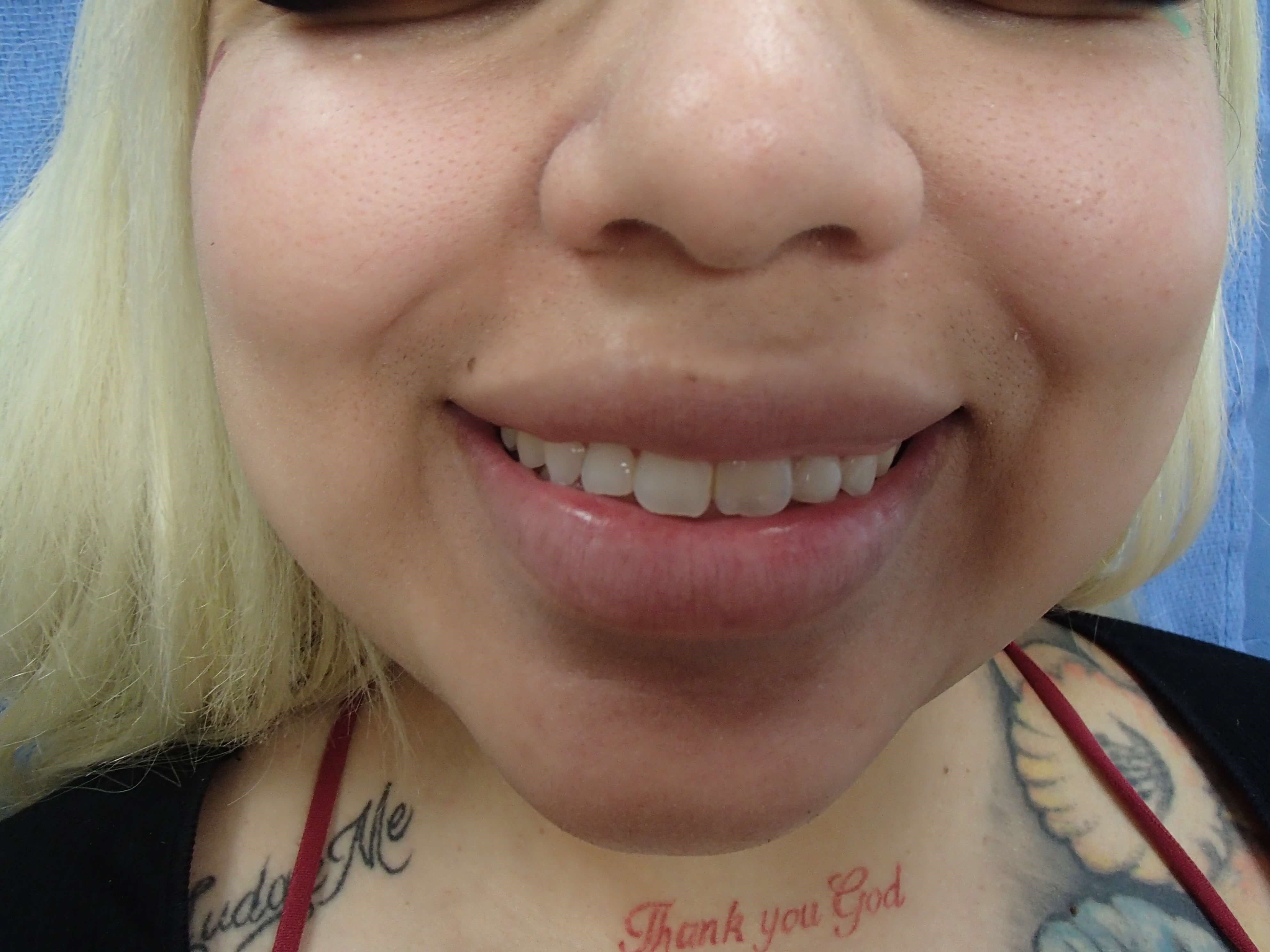 Timeless Dimples Before
