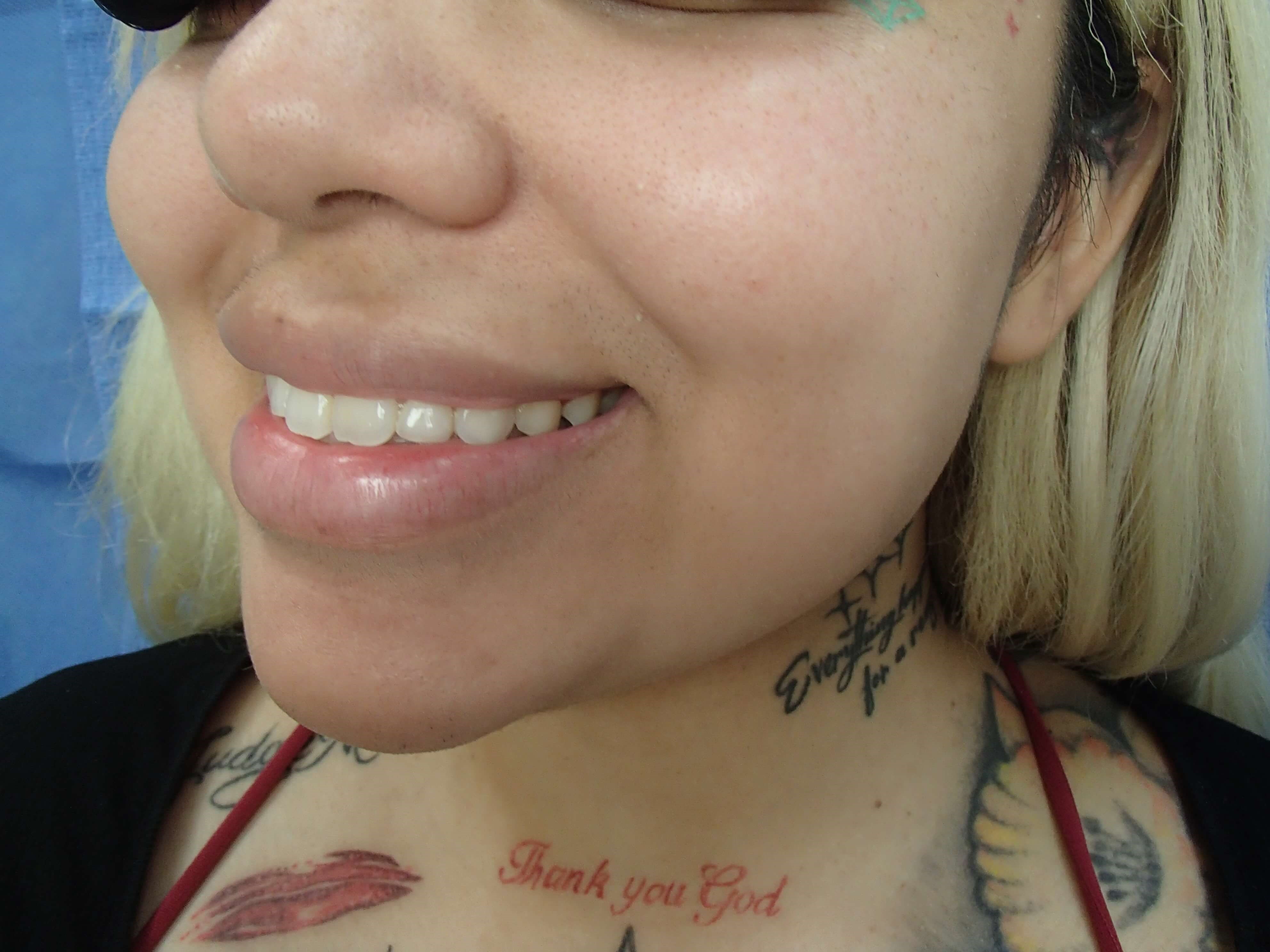 Timeless Dimples Before
