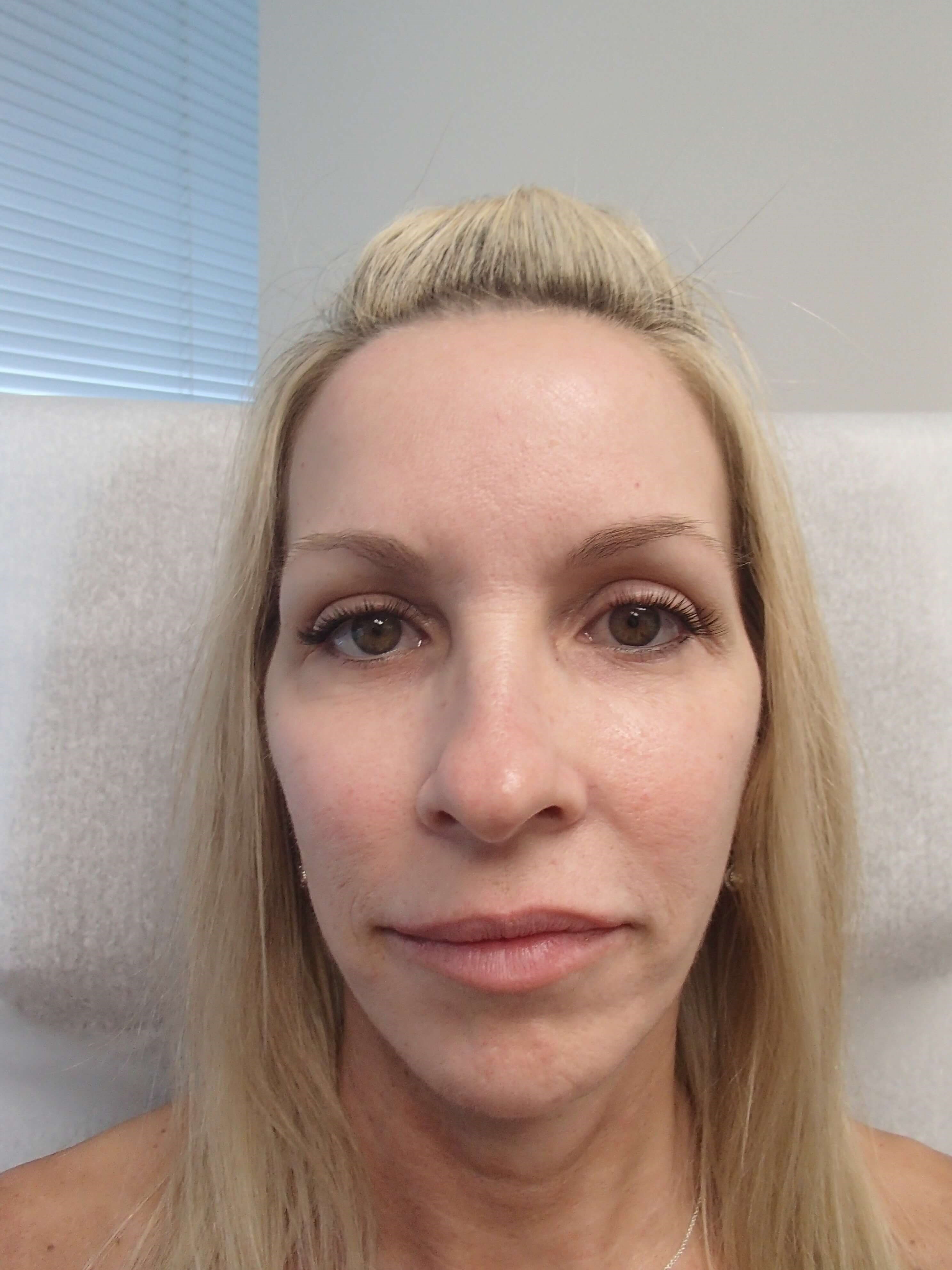 Blepharoplasty - eyelid lift After