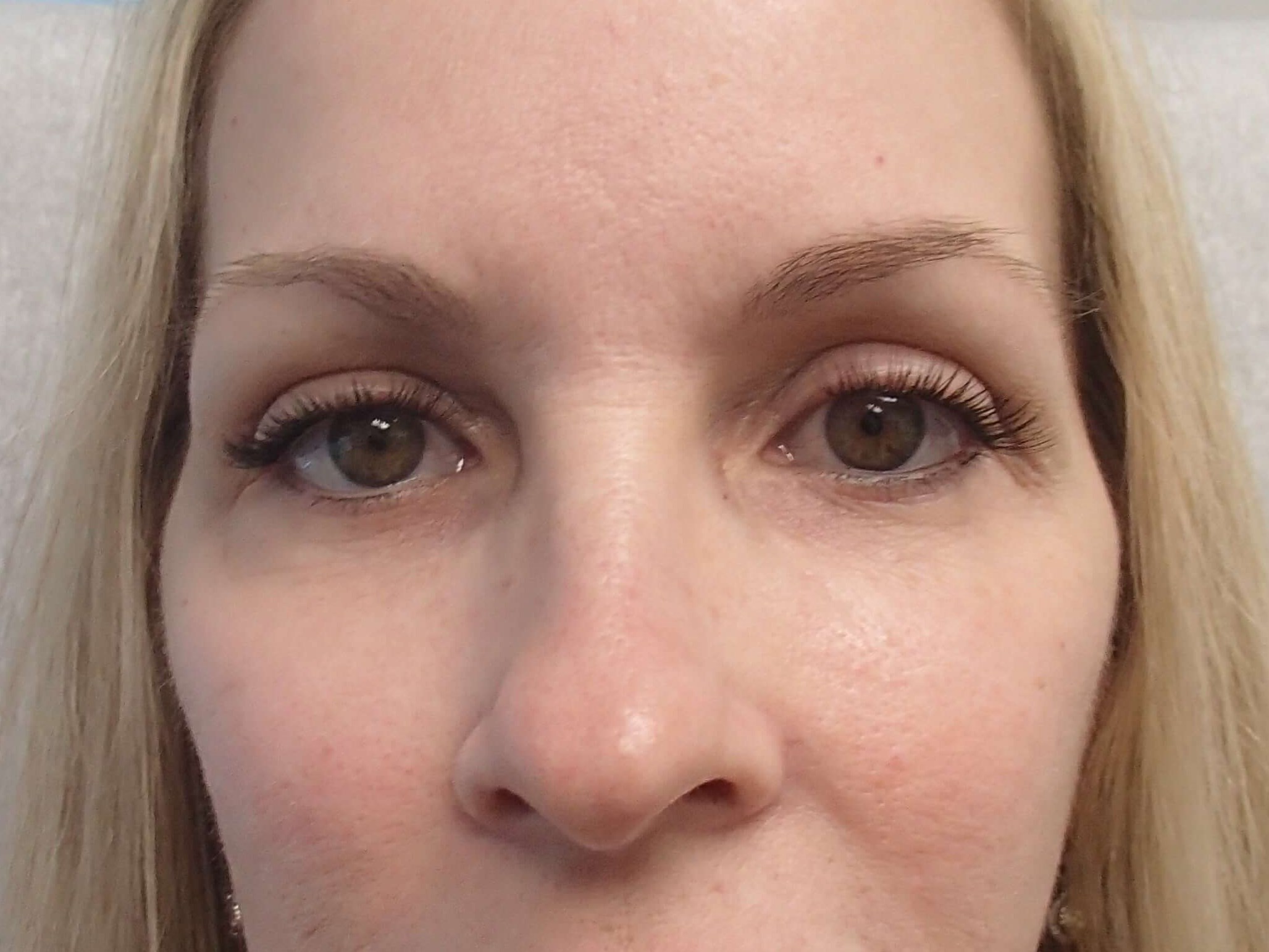 Blepharoplasty - eyelid lift After