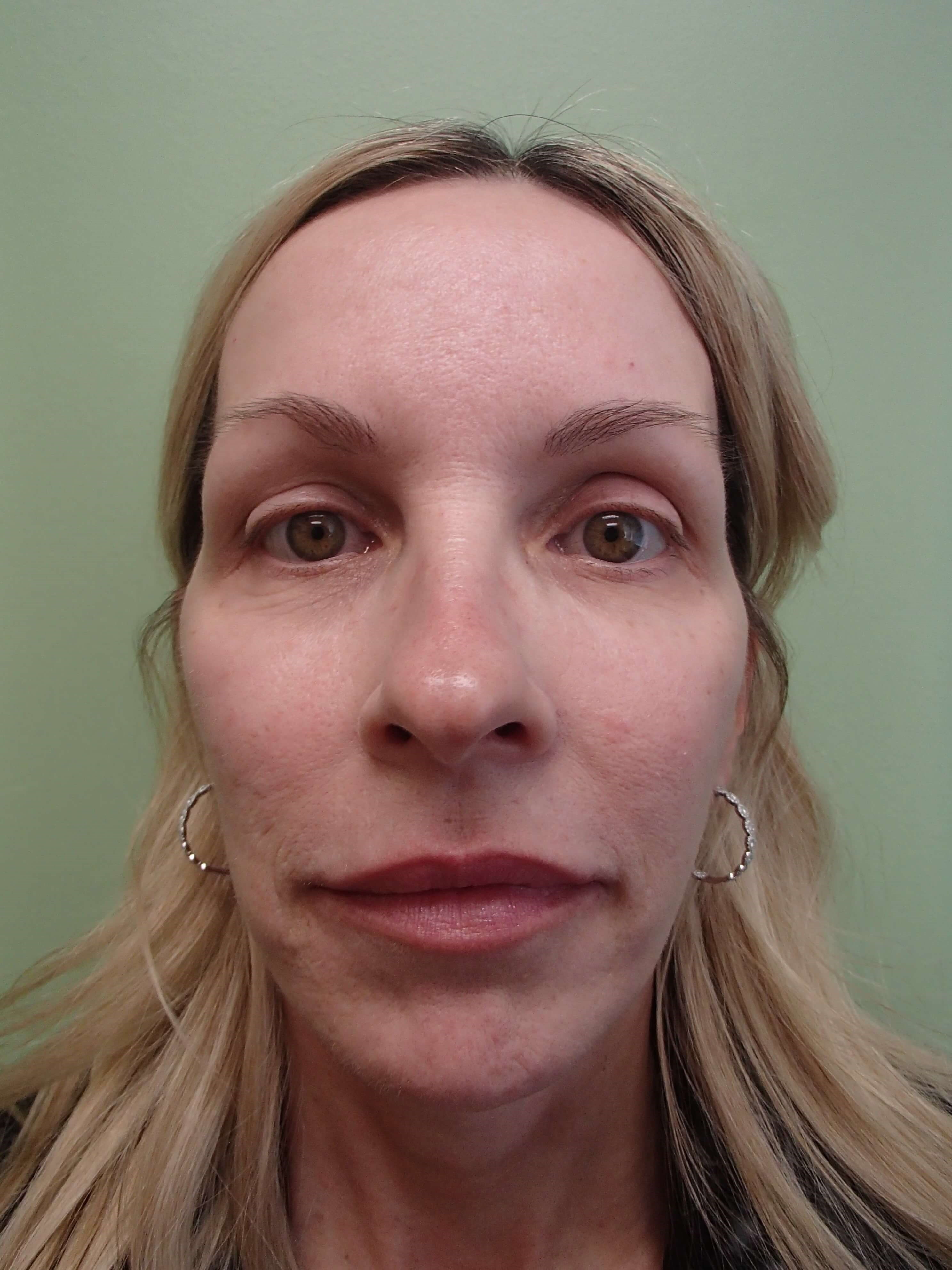 Blepharoplasty - eyelid lift Before