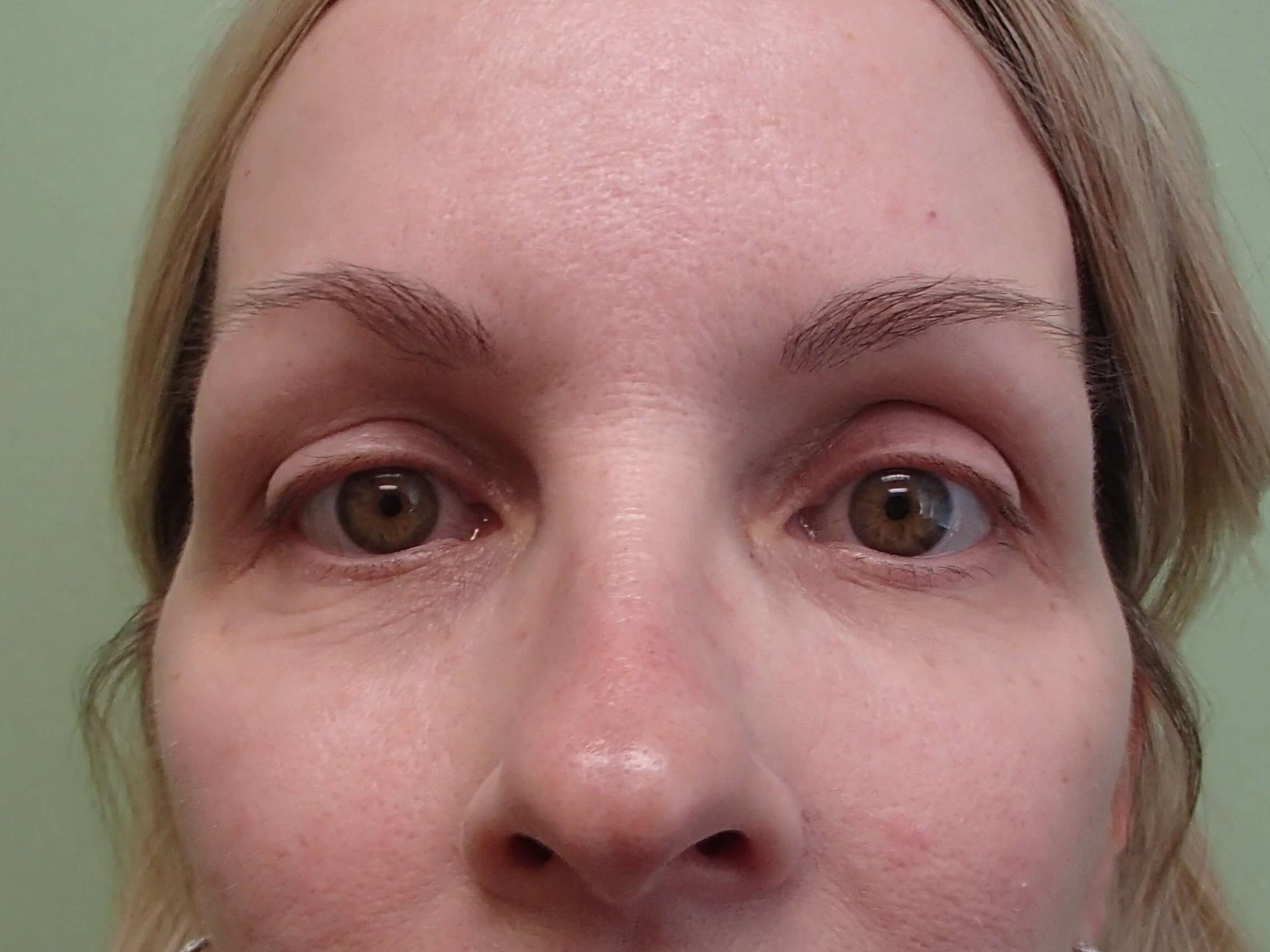 Blepharoplasty - eyelid lift Before