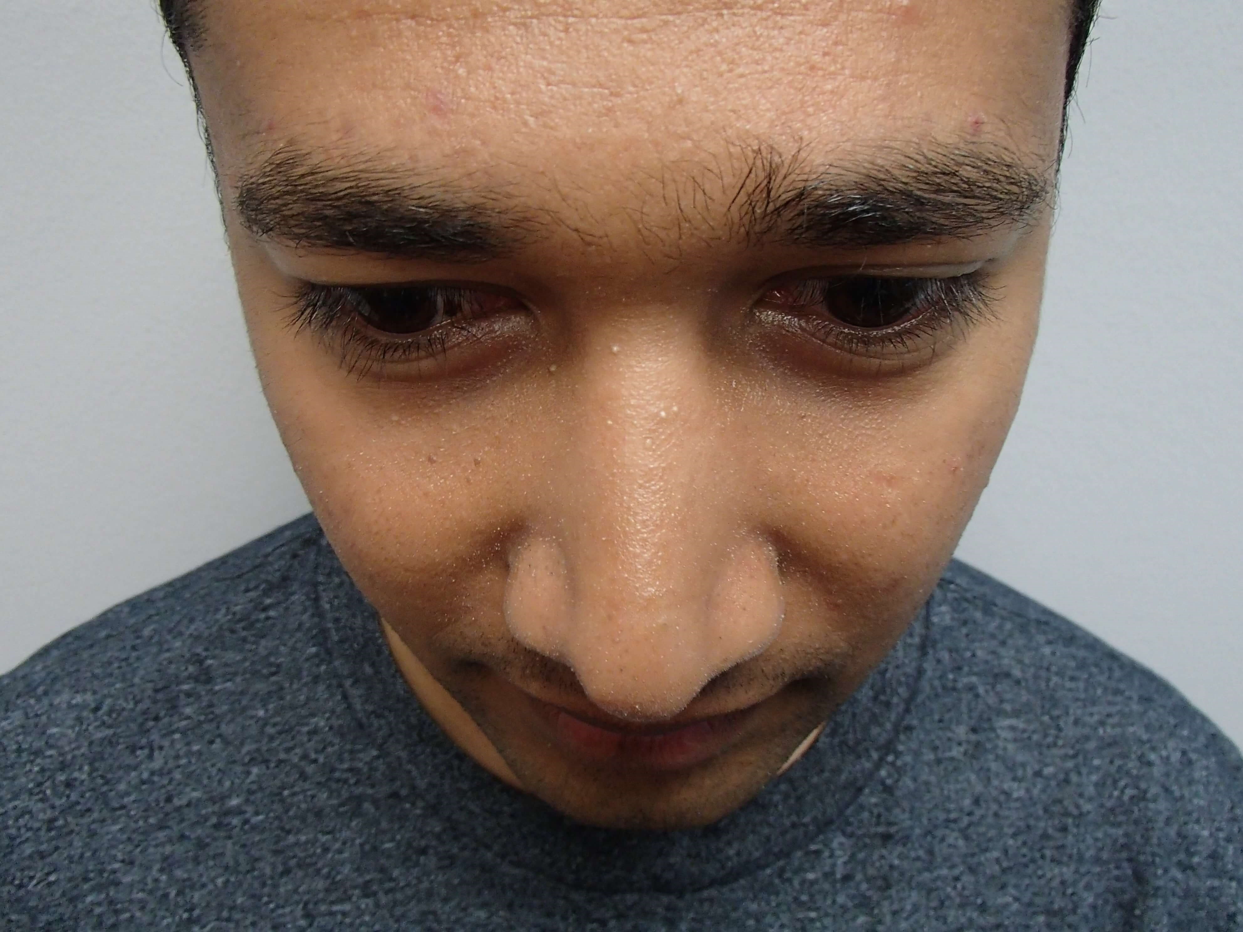 Rhinoplasty (Nose Job) After
