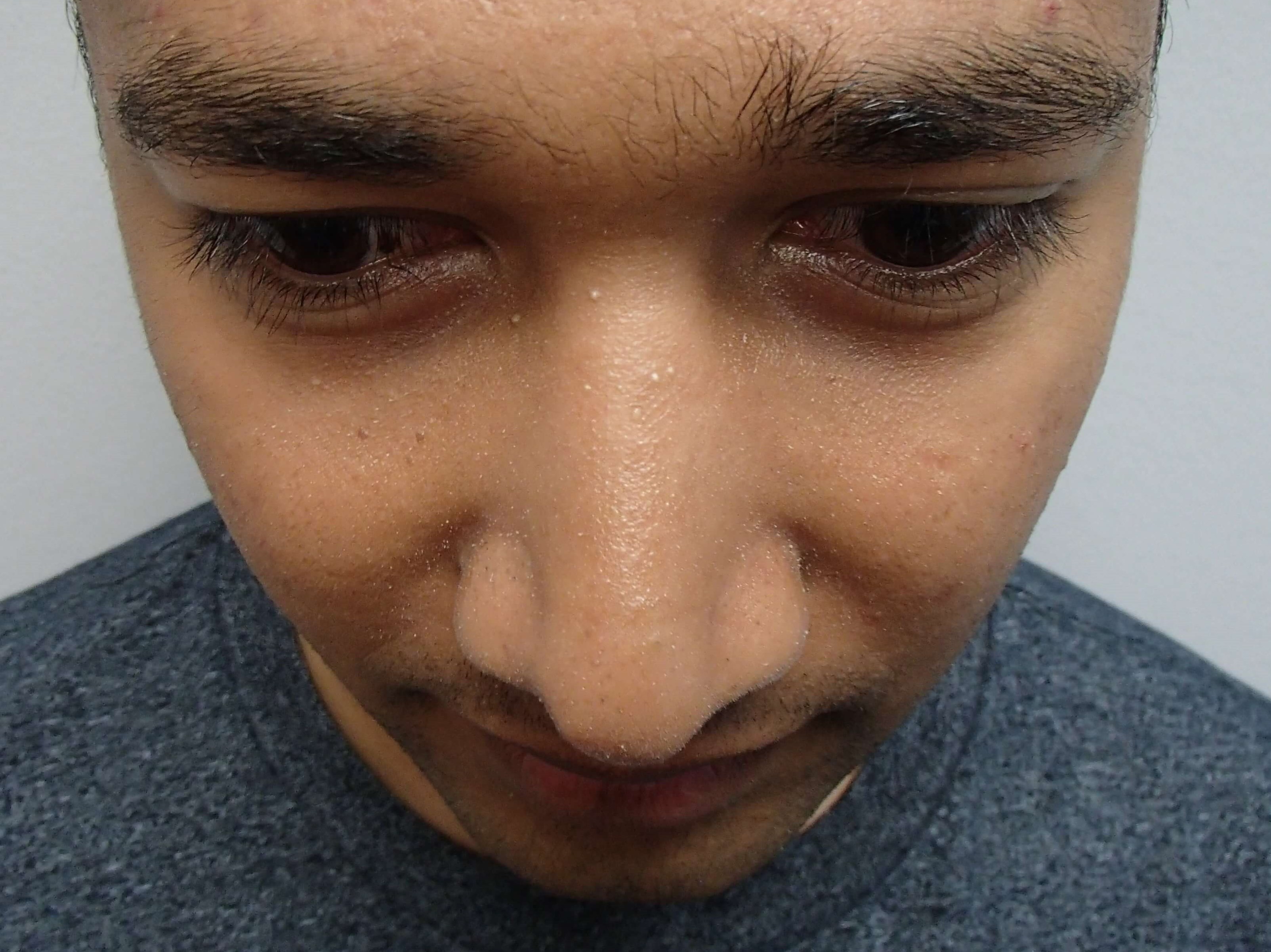 Rhinoplasty (Nose Job) After