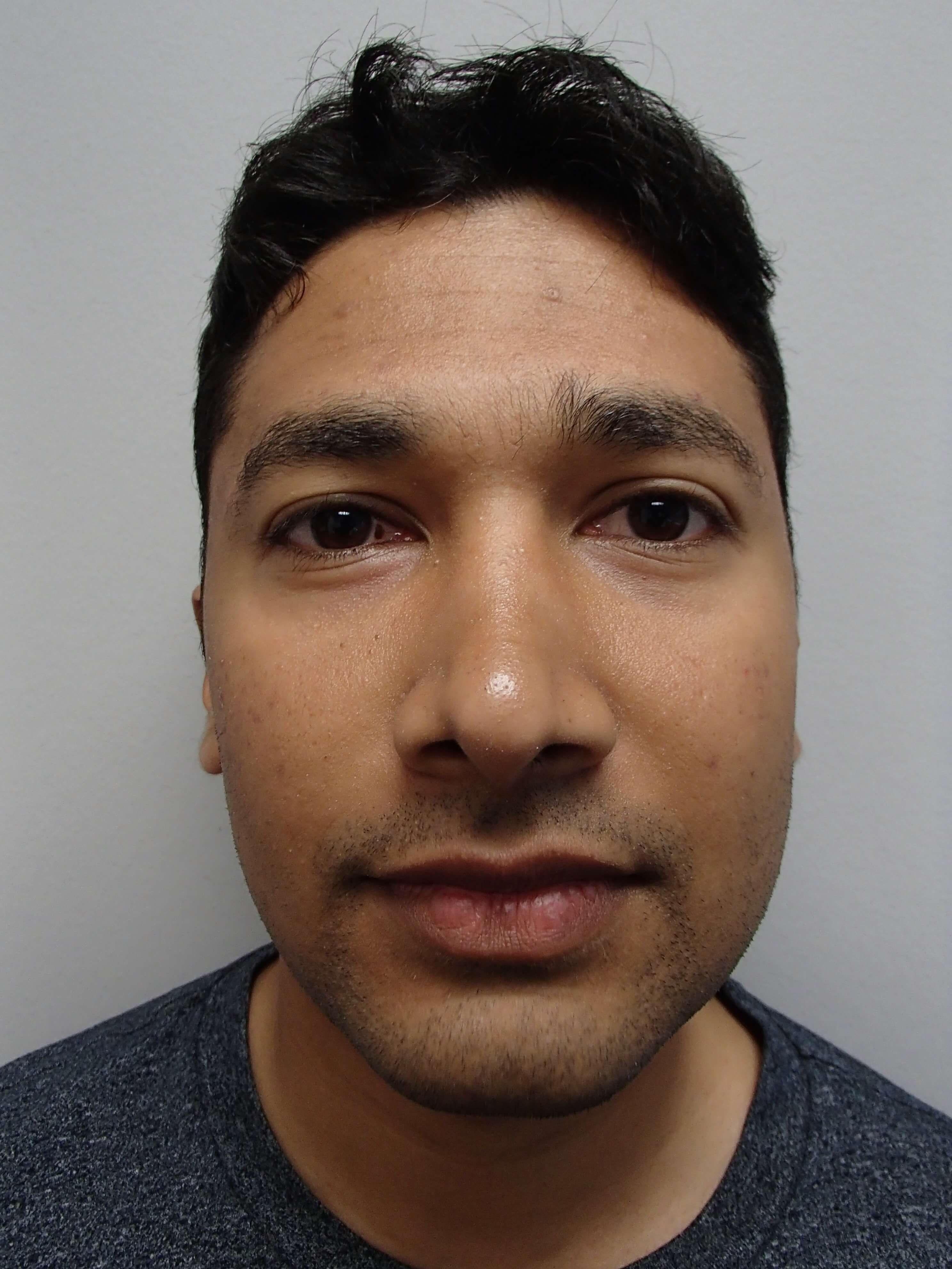 Rhinoplasty (Nose Job) After