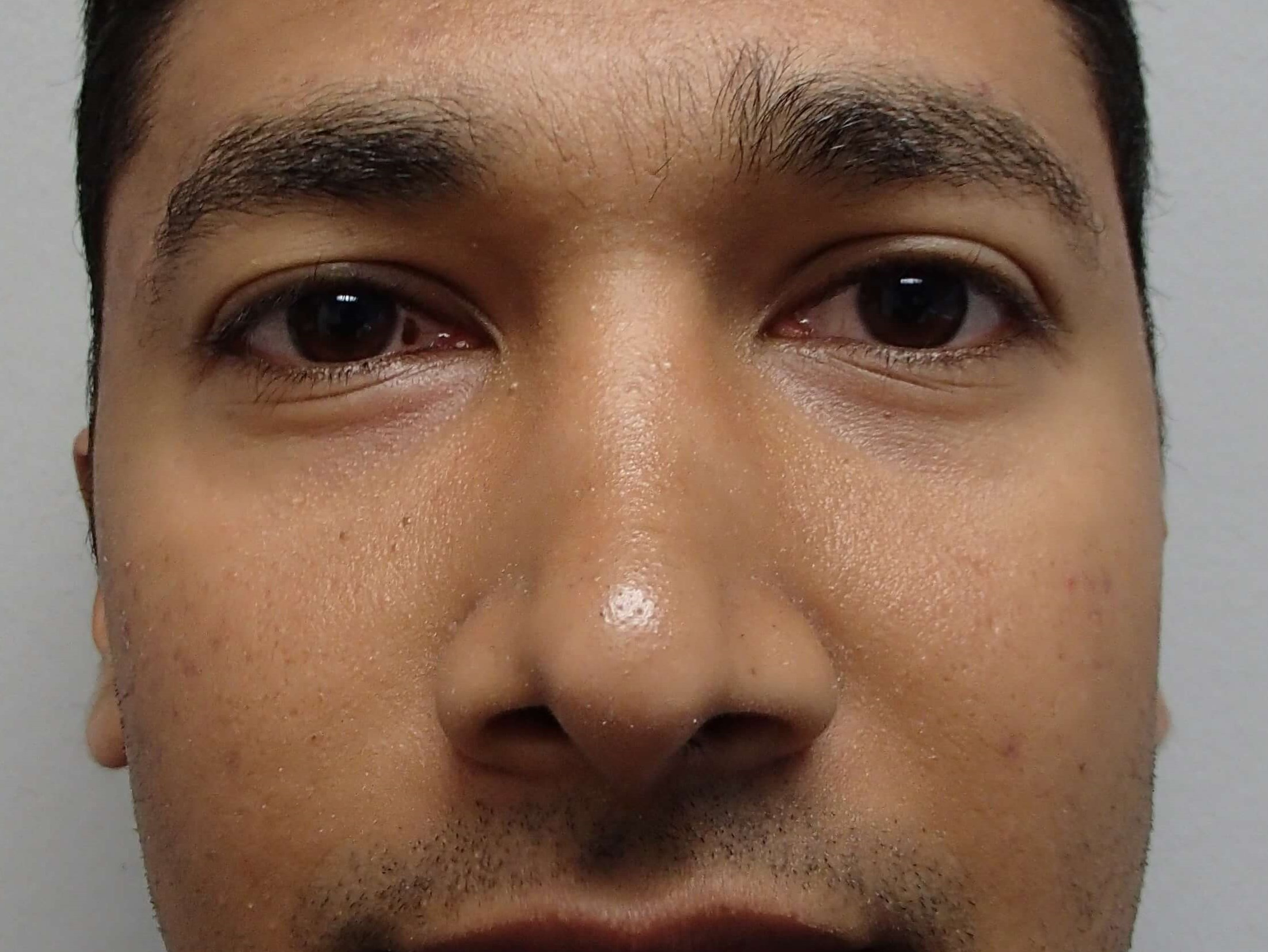 Rhinoplasty (Nose Job) After