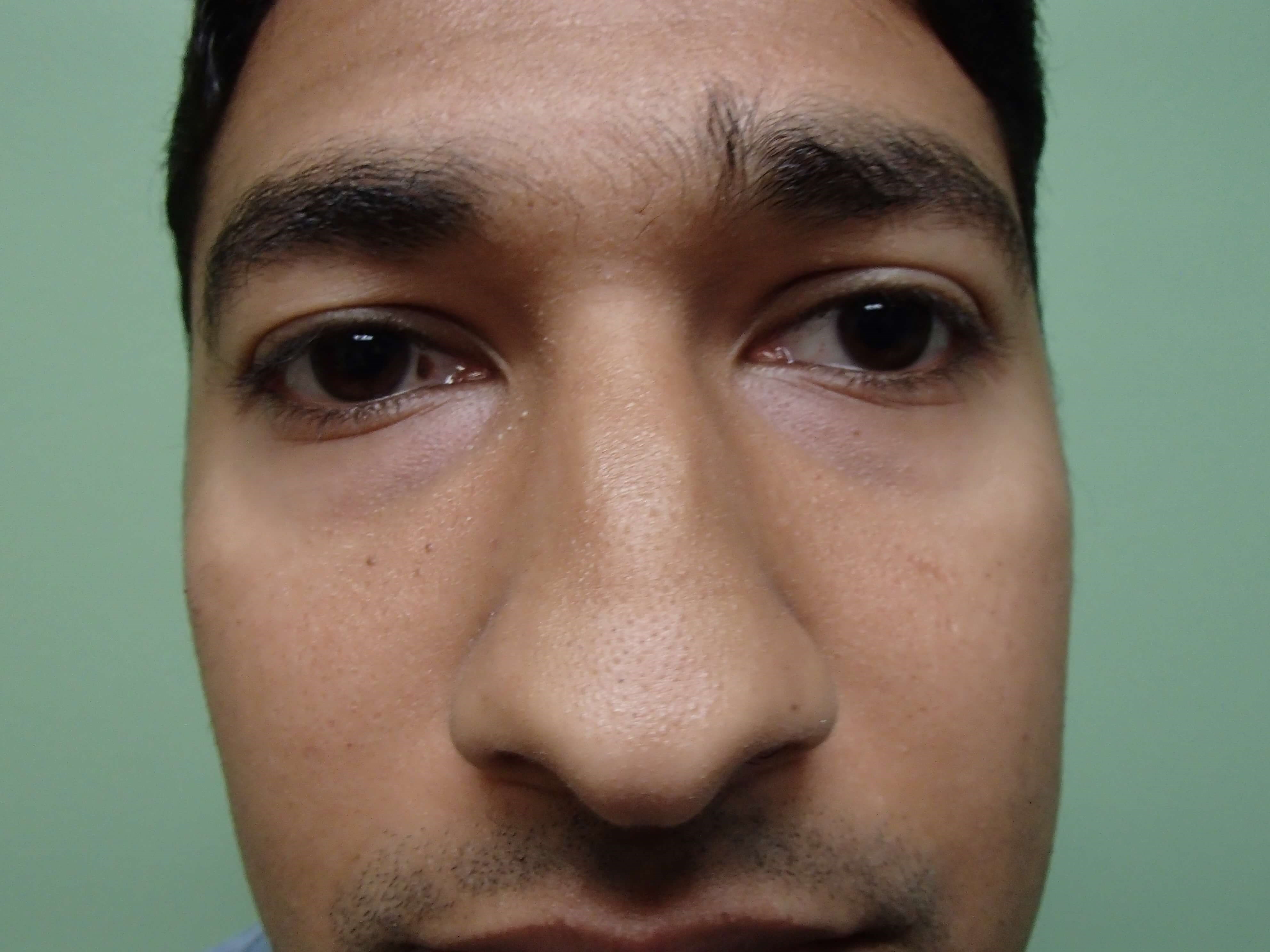 Rhinoplasty (Nose Job) Before