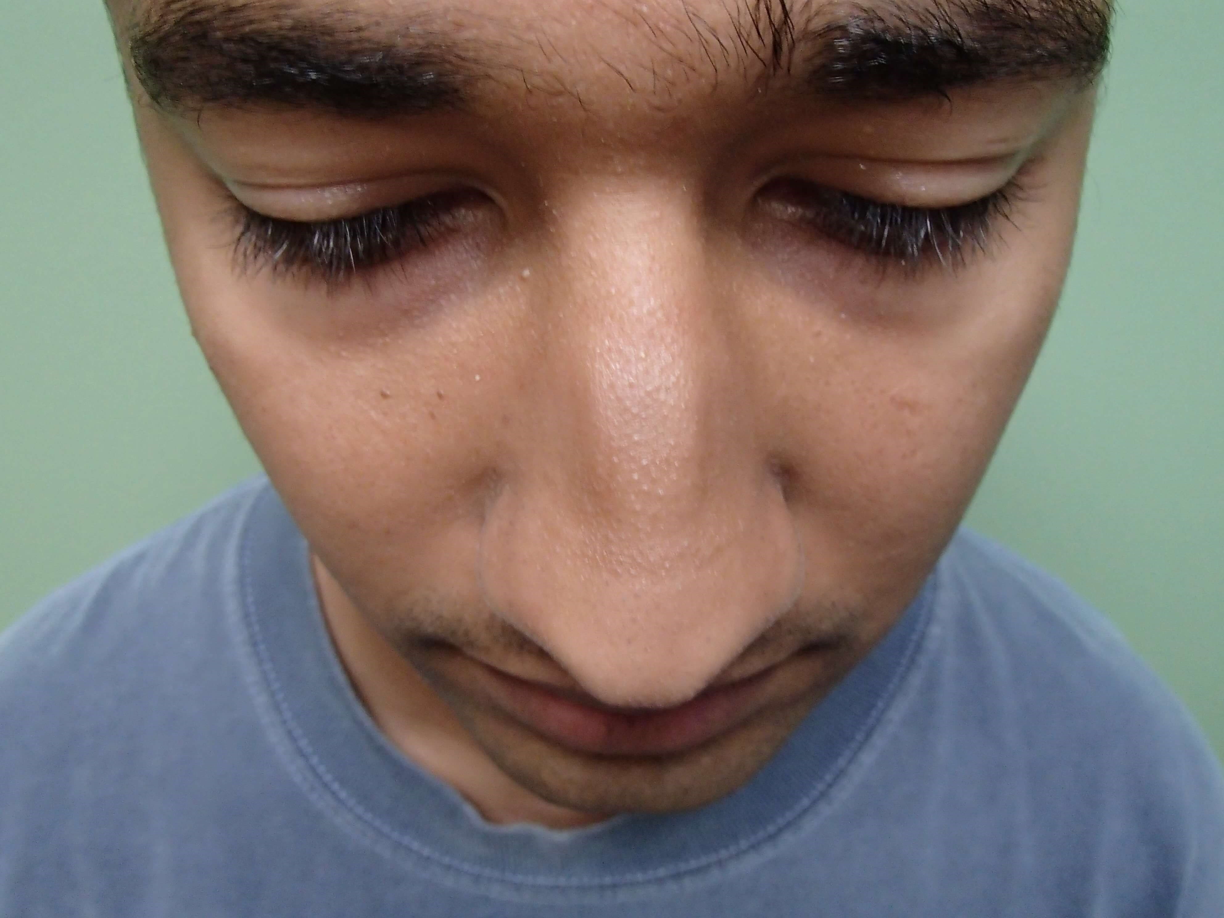Rhinoplasty (Nose Job) Before