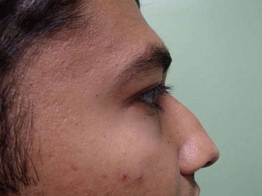 Rhinoplasty (Nose Job) Before
