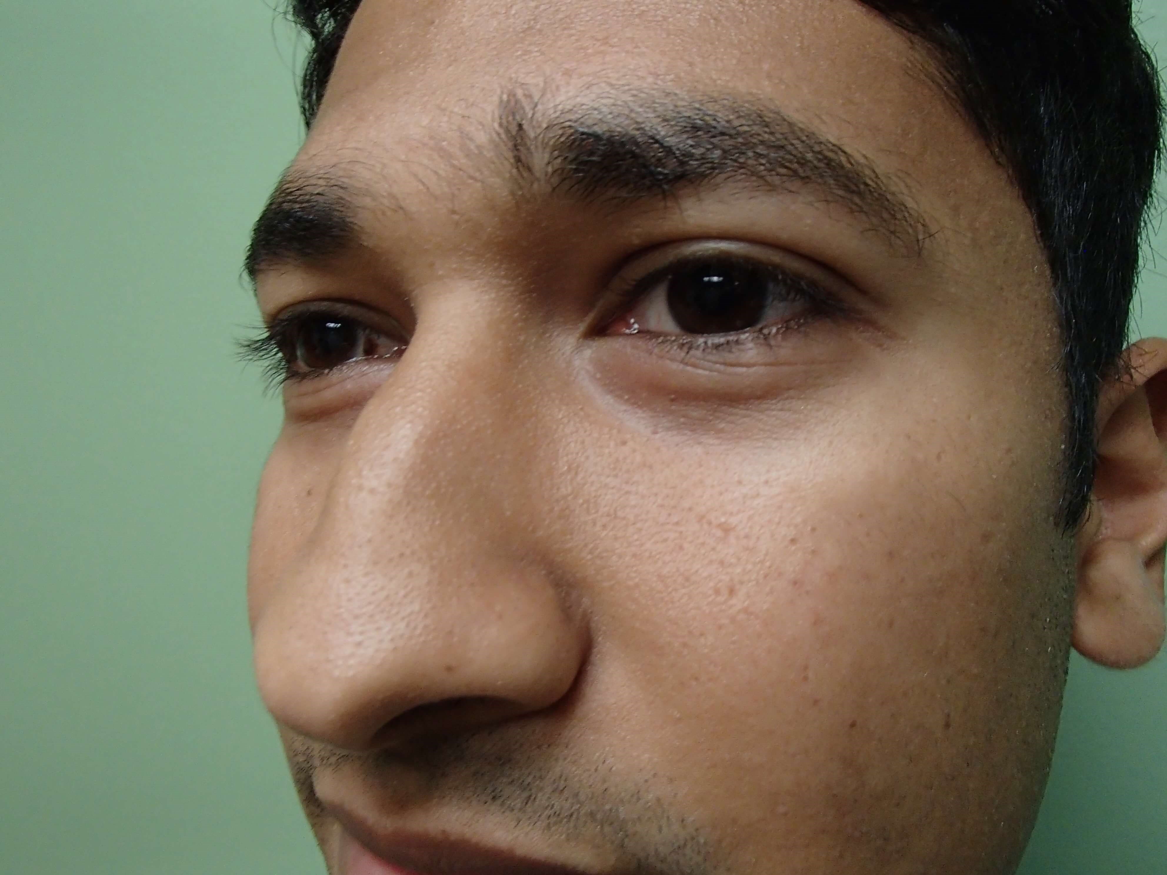 Rhinoplasty (Nose Job) Before
