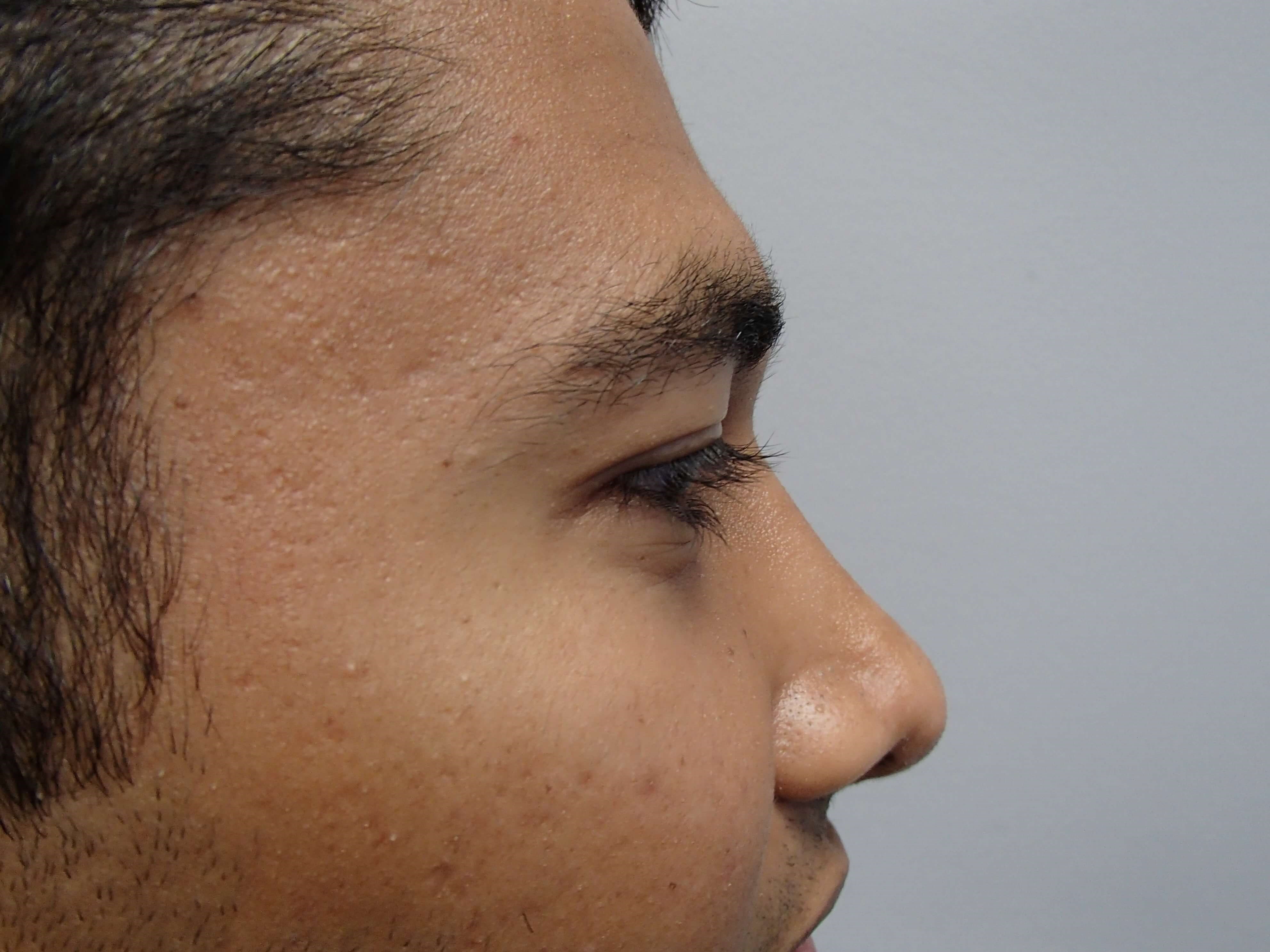 Rhinoplasty (Nose Job) After