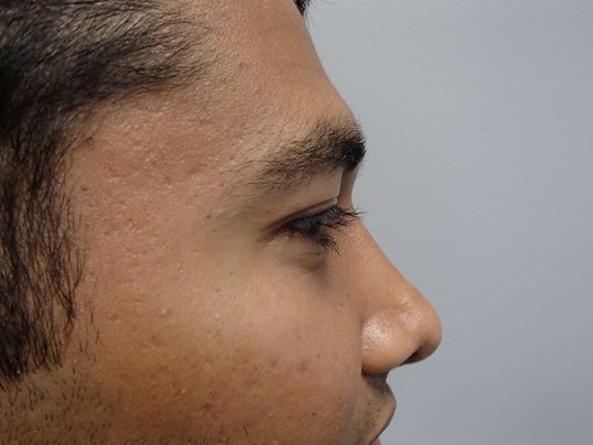 Rhinoplasty (Nose Job) After