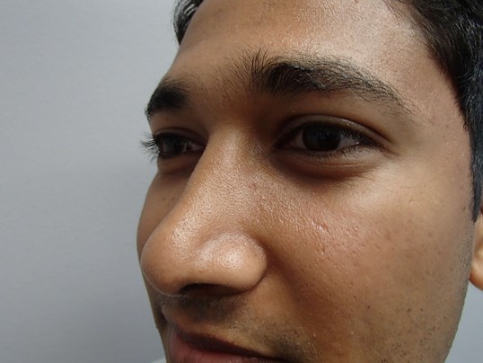 Rhinoplasty (Nose Job) After