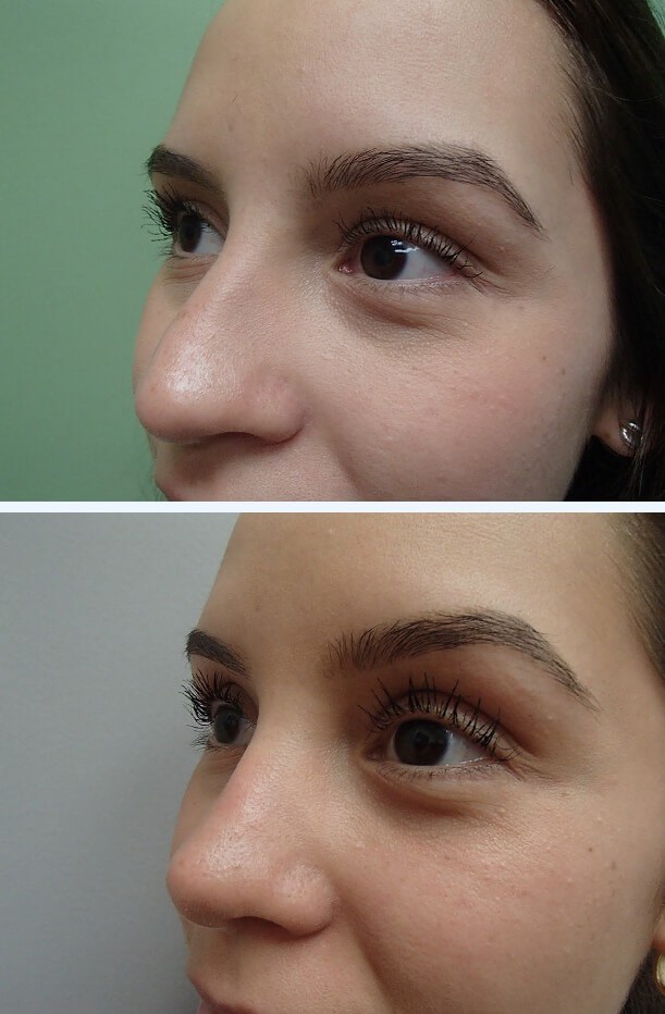 Rhinoplasty (Nose Job) Before