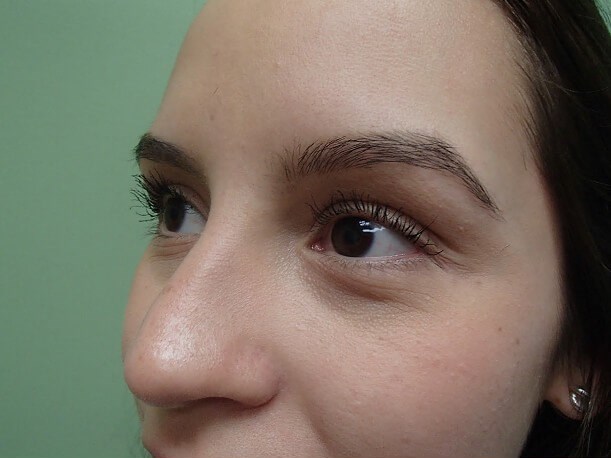 Rhinoplasty (Nose Job) Before