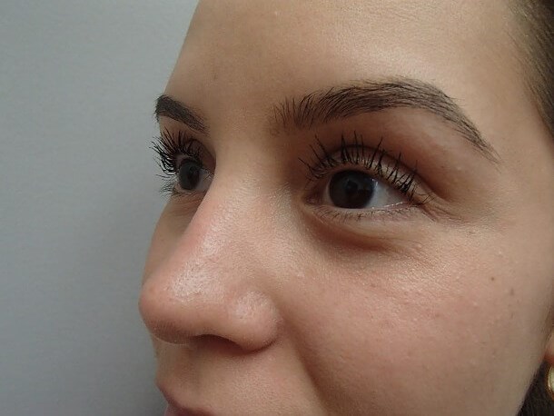 Rhinoplasty (Nose Job) After