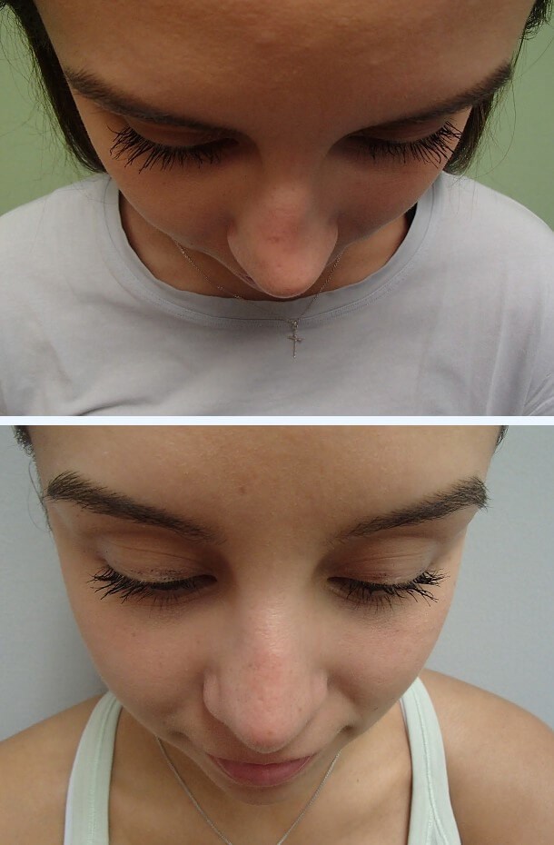 Rhinoplasty (Nose Job) Before