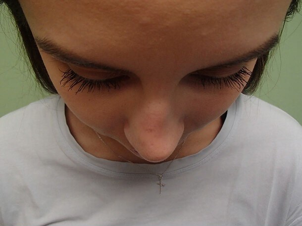 Rhinoplasty (Nose Job) Before