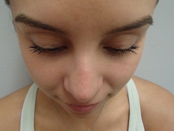 Rhinoplasty (Nose Job) After