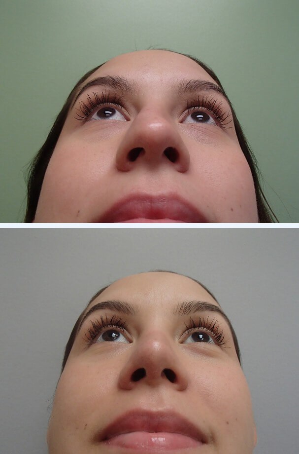Rhinoplasty (Nose Job) Before